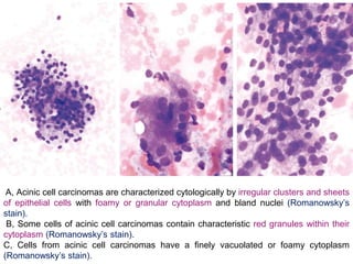 A, Acinic cell carcinomas are characterized cytologically by irregular clusters and sheets
of epithelial cells with foamy or granular cytoplasm and bland nuclei (Romanowsky’s
stain).
B, Some cells of acinic cell carcinomas contain characteristic red granules within their
cytoplasm (Romanowsky’s stain).
C, Cells from acinic cell carcinomas have a finely vacuolated or foamy cytoplasm
(Romanowsky’s stain).
 