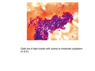 Cells are in tight cluster with scanty to moderate cytoplasm
(H & E)
 
