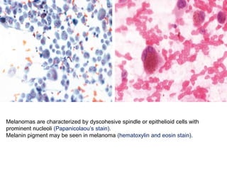 Melanomas are characterized by dyscohesive spindle or epithelioid cells with
prominent nucleoli (Papanicolaou’s stain).
Melanin pigment may be seen in melanoma (hematoxylin and eosin stain).
 