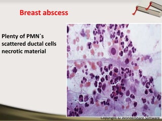 Breast abscess
Plenty of PMN`s
scattered ductal cells
necrotic material

Copyright © Wondershare Software

 