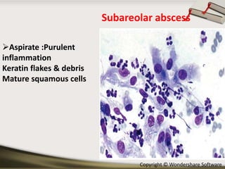 Subareolar abscess
Aspirate :Purulent
inflammation
Keratin flakes & debris
Mature squamous cells

Copyright © Wondershare Software

 