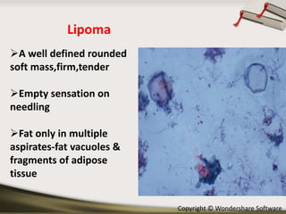 Lipoma
A well defined rounded
soft mass,firm,tender
Empty sensation on
needling
Fat only in multiple
aspirates-fat vacuoles &
fragments of adipose
tissue
Copyright © Wondershare Software

 