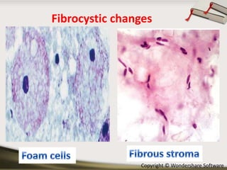Fibrocystic changes

Copyright © Wondershare Software

 