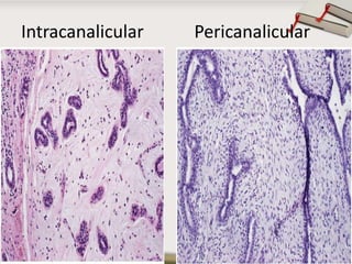 Intracanalicular

Pericanalicular

Copyright © Wondershare Software

 