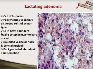 Lactating adenoma
Cell rich smears
Poorly cohesive mainly
dispersed cells of acinar
type
Cells have abundant
fragile cytoplasm,some bare
nuclei
Rounded vesicular nuclei
& central nucleoli
Background of abundant
lipid secretion

Copyright © Wondershare Software

 