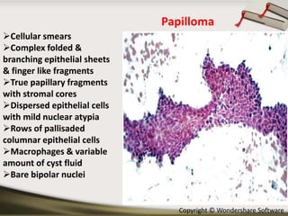 Papilloma
Cellular smears
Complex folded &
branching epithelial sheets
& finger like fragments
True papillary fragments
with stromal cores
Dispersed epithelial cells
with mild nuclear atypia
Rows of pallisaded
columnar epithelial cells
Macrophages & variable
amount of cyst fluid
Bare bipolar nuclei

Copyright © Wondershare Software

 