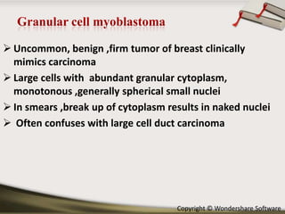  Uncommon, benign ,firm tumor of breast clinically
mimics carcinoma
 Large cells with abundant granular cytoplasm,
monotonous ,generally spherical small nuclei
 In smears ,break up of cytoplasm results in naked nuclei
 Often confuses with large cell duct carcinoma

Copyright © Wondershare Software

 