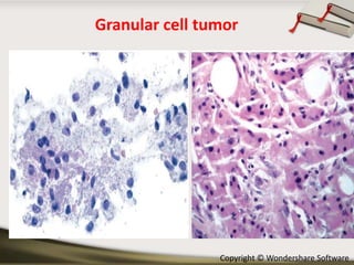 Granular cell tumor

Copyright © Wondershare Software

 