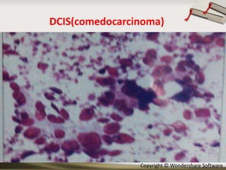 DCIS(comedocarcinoma)

Copyright © Wondershare Software

 