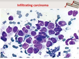 Infiltrating carcinoma

Copyright © Wondershare Software

 