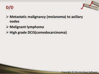  Metastatic malignancy (melanoma) to axillary
nodes
 Malignant lymphoma
 High grade DCIS(comedocarcinoma)

Copyright © Wondershare Software

 