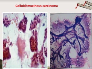 Colloid/mucinous carcinoma

Copyright © Wondershare Software

 