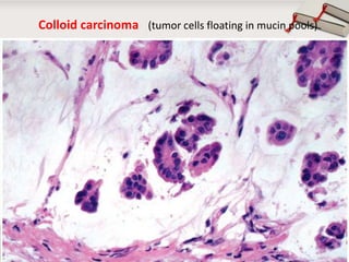 Colloid carcinoma (tumor cells floating in mucin pools)

Copyright © Wondershare Software

 