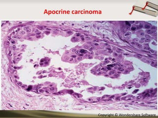 Apocrine carcinoma

Copyright © Wondershare Software

 