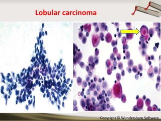 Lobular carcinoma

Copyright © Wondershare Software

 