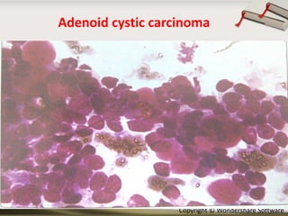 Adenoid cystic carcinoma

Copyright © Wondershare Software

 