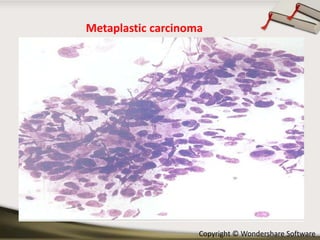 Metaplastic carcinoma

Copyright © Wondershare Software

 