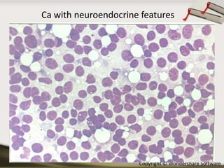 Ca with neuroendocrine features

Copyright © Wondershare Software

 
