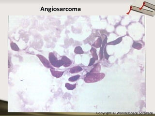 Angiosarcoma

Copyright © Wondershare Software

 
