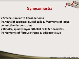 Gynecomastia
Smears similar to fibroadenoma
Sheets of cuboidal ductal cells & fragments of loose
connective tissue stroma
Bipolar, spindly myoepithelial cells & oncocytes
Fragments of fibrous stroma & adipose tissue

Copyright © Wondershare Software

 