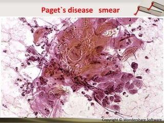 Paget`s disease smear

Copyright © Wondershare Software

 