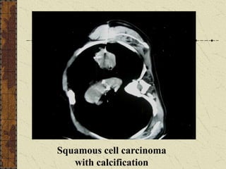 Squamous cell carcinoma
with calcification
 