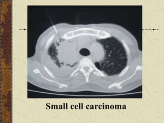 Small cell carcinoma
 