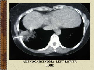 ADENOCARCINOMA LEFT LOWER
LOBE
 