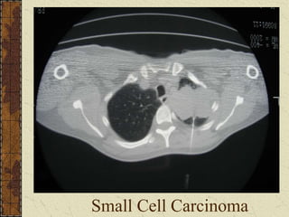Small Cell Carcinoma
 