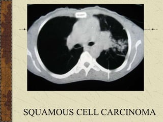 SQUAMOUS CELL CARCINOMA
 