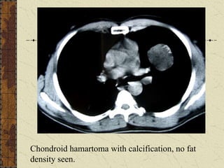 Chondroid hamartoma with calcification, no fat
density seen.
 