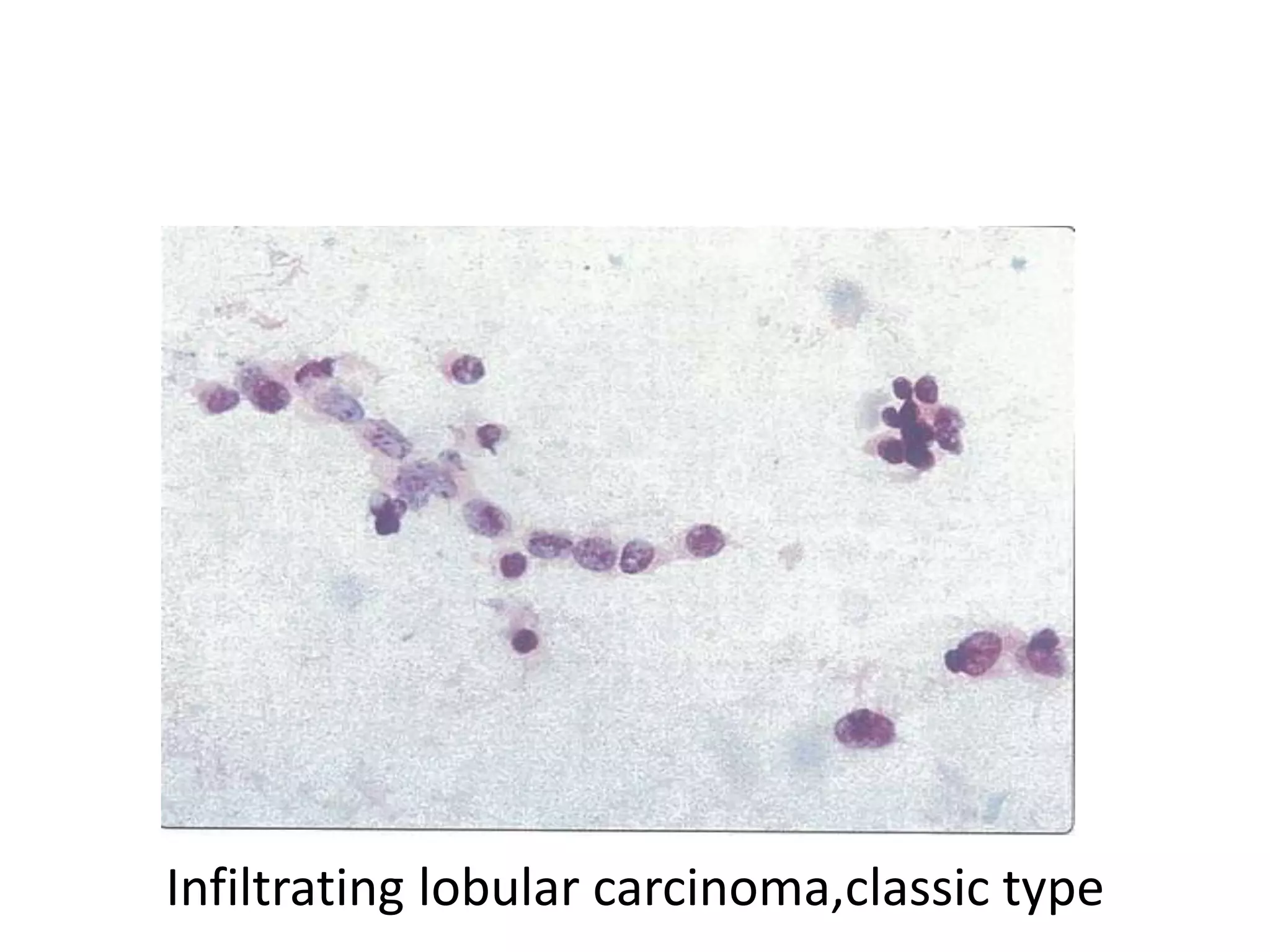 Infiltrating lobular carcinoma,classic type

 