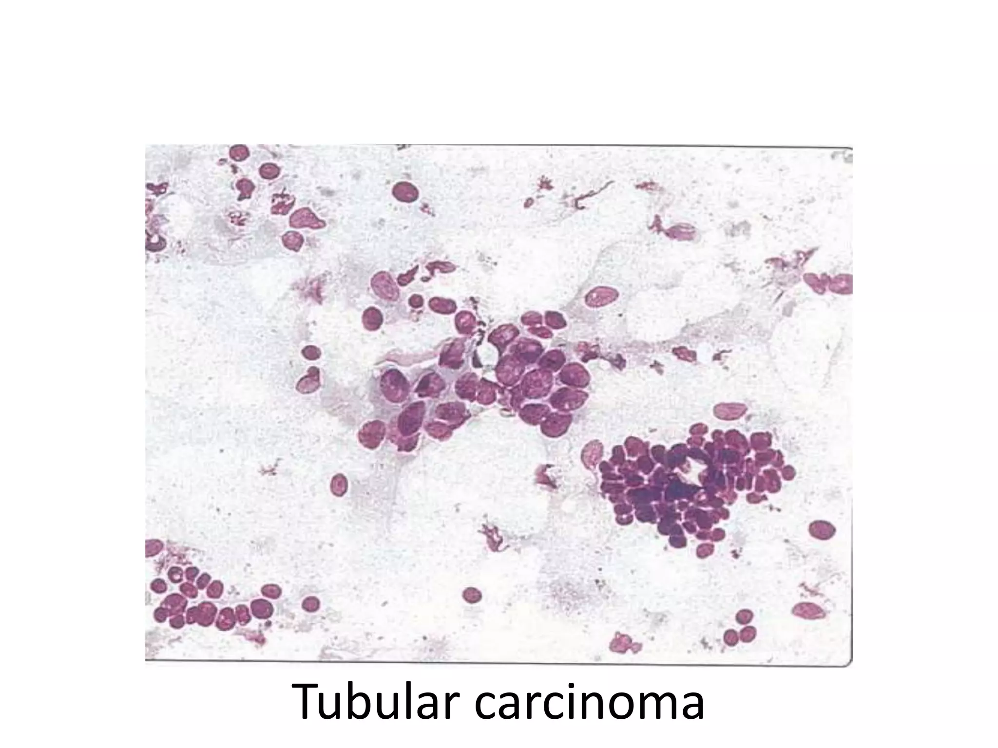 Tubular carcinoma

 