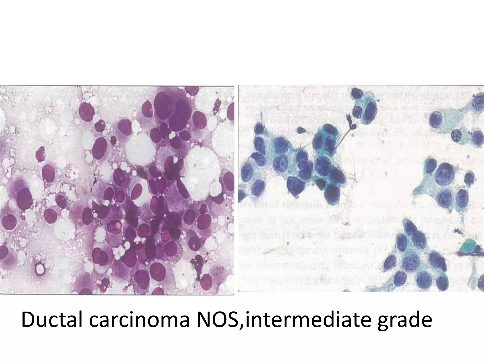 Ductal carcinoma NOS,intermediate grade

 