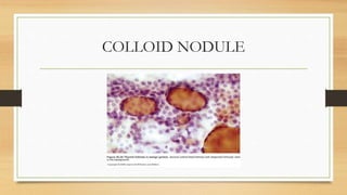 COLLOID NODULE
 