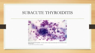 SUBACUTE THYROIDITIS
 