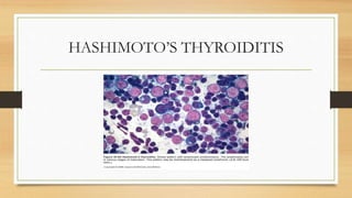HASHIMOTO’S THYROIDITIS
 
