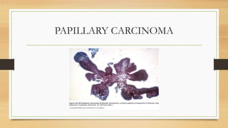 PAPILLARY CARCINOMA
 