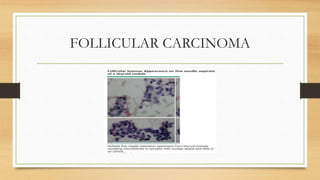 FOLLICULAR CARCINOMA
 