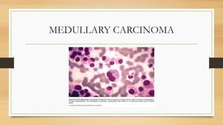 MEDULLARY CARCINOMA
 
