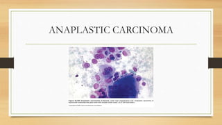 ANAPLASTIC CARCINOMA
 