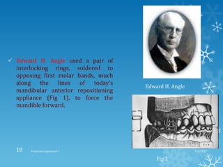  Edward H. Angle used a pair of
interlocking rings, soldered to
opposing first molar bands, much
along the lines of today’s
mandibular anterior repositioning
appliance (Fig 1), to force the
mandible forward.
Edward H. Angle
Fig 1
9/2/2013Functional appliances- I18
 