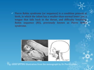  Pierre Robin syndrome (or sequence) is a condition present at
birth, in which the infant has a smaller-than-normal lower jaw, a
tongue that falls back in the throat, and difficulty breathing.
Robin sequence (RS), previously known as Pierre Robin
syndrome.
Fig: these are two illustration from the monograph by Dr Pierre robin
9/2/2013Functional appliances- I21
 