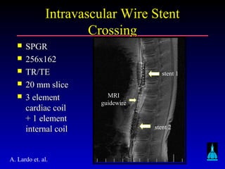 Johns Hopkins University
Intravascular Wire StentIntravascular Wire Stent
CrossingCrossing
 SPGRSPGR
 256x162256x162
 TR/TETR/TE
 20 mm slice20 mm slice
 3 element3 element
cardiac coilcardiac coil
+ 1 element+ 1 element
internal coilinternal coil
stent 1
stent 2
MRI
guidewire
A. Lardo et. al.
 
