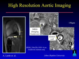 Johns Hopkins University
High Resolution Aortic ImagingHigh Resolution Aortic Imaging
stent
MRIG
(Imaging
Guidewire)
SPGR, 256x256, FOV=4 cm
Guidewire element only
stented
wall
156µm
A. Lardo et. al.
 