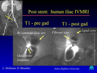 Johns Hopkins University
Post stent: human iliac IVMRIPost stent: human iliac IVMRI
L. Hofmann, D. Bluemke
Rt common iliac art.
Guidewire
(venous)
Fibrous cap
Lipid core
T1 - pre gad T1 - post gad
 