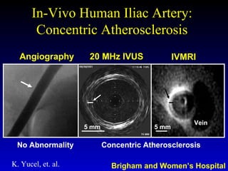 In-Vivo Human Iliac Artery:In-Vivo Human Iliac Artery:
Concentric AtherosclerosisConcentric Atherosclerosis
Angiography 20 MHz IVUS IVMRI
No Abnormality Concentric Atherosclerosis
5 mm 5 mm
Vein
K. Yucel, et. al. Brigham and Women’s Hospital
 