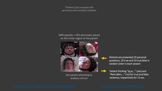 ALS patient attending to
auditory stimuli
NIRS optodes + EEG electrodes placed
on the motor region of the patient
Patients are presented 20 personal
questions, 10 true and 10 true false in
random order in each session
Patient thinking “ja,ja,…” (yes) and
“Nein,Nein,…” (no) for true and false
sentence, respectively for 15 sec.
*Patient’s face revealed with
permission from primary caretaker
Chaudhary et al., PLoS Biology 2017.Chaudhary et al., Nature Reviews Neurology 2016
 