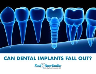 CAN DENTAL IMPLANTS FALL OUT?
 