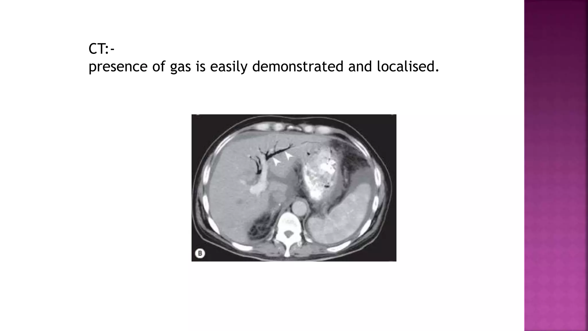 CT:-
presence of gas is easily demonstrated and localised.
 
